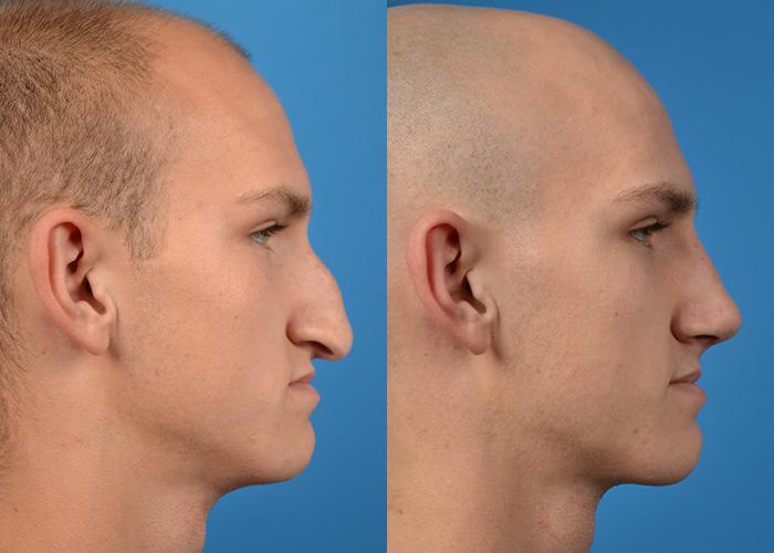 Male Rhinoplasty Melbourne Fl Patient